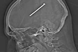 Three inch nail removed from man's brain