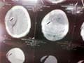 Man survives piece of wood stuck in brain