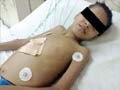 11-year-old survives cardiac failure after rare infection