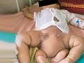 Surgery to remove extra feet from 10-month-old