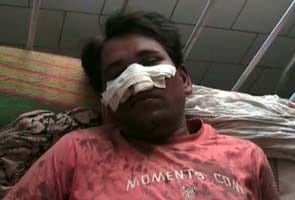Upper caste men chopped off his nose for riding a motorcycle