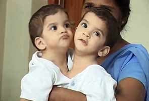 Betul's baby Aradhana passes away, was conjoined twin till recently