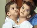 Betul's baby Aradhana passes away, was conjoined twin till recently