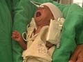 Baby Damini to be discharged from hospital today