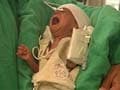 Baby Damini to be discharged from hospital today