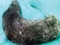 Hairball weighing 1.6 kg removed from teen's stomach