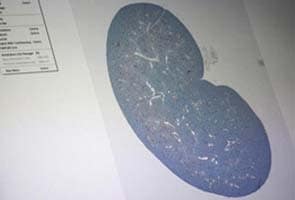 Lab-made rat kidneys raise hopes for dialysis patients