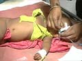 15 children die of encephalitis in Uttar Pradesh, toll reaches 271 this year