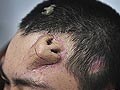 Chinese doctor builds new nose on man's forehead