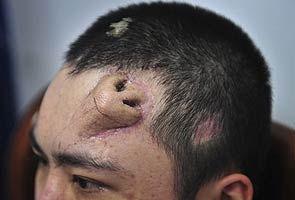 Chinese doctor builds new nose on man's forehead