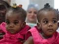 Indian doctors successfully separate Nigerian conjoined twins
