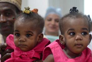 Indian doctors successfully separate Nigerian conjoined twins