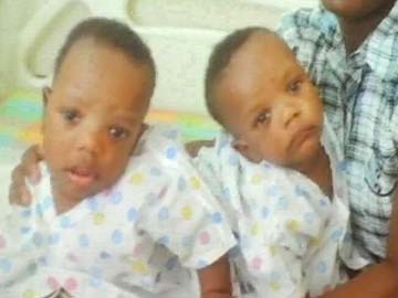 Chennai: Tanzanian conjoined twins separated, are stable, say doctors