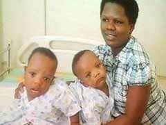 Tanzanian conjoined twins to be separated in Chennai hospital tomorrow