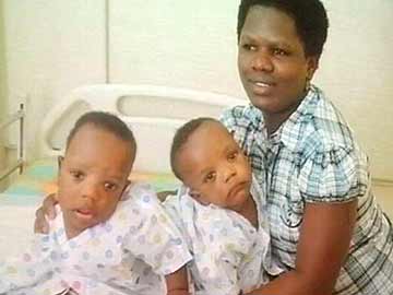 Tanzanian conjoined twins to be separated in Chennai hospital tomorrow