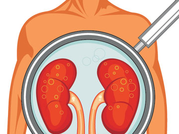 Robotic kidney transplants are here