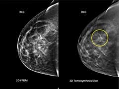 What To Expect When Getting A Mammogram