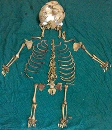 Doctors Remove Skeleton of Foetus Inside Indian Woman for 36 Years