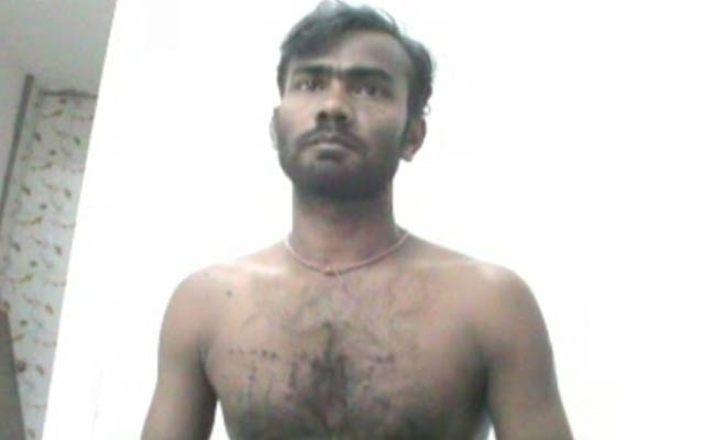 BJP Worker Burned With Cigarette Butts for 'Attending Amit Shah's Kolkata Rally'