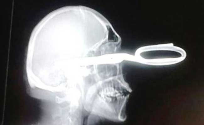 Man with Scissors Lodged in Head Politely Asks for Help