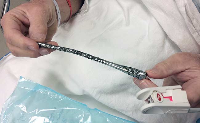 51 Years After Wreck, 7-inch Car Part Found in Arm