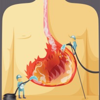 Simple Tips to Reduce Stomach Acid