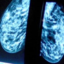  Breast Cancer Drug Perjeta Could Extend Patients' Lives by 15 Months - Study