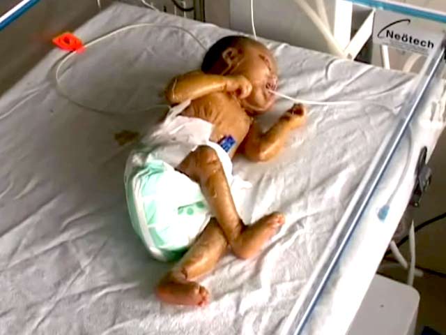 हरियाणा : प्लास्टिक जैसी स्किन वाले बच्चे का जन्म