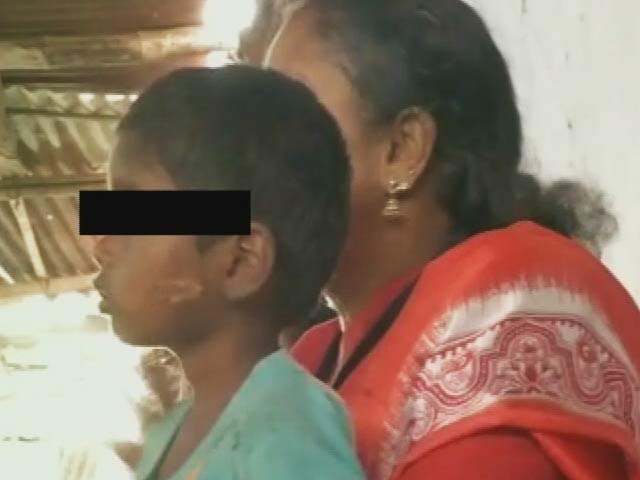 3-Year-Old Burnt With Hot Spoon For 'Not Obeying' Grandparents