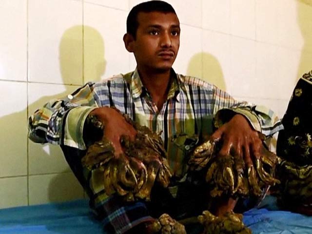Video : Surgery for Bangladesh's 'Tree Man' to Remove Warts