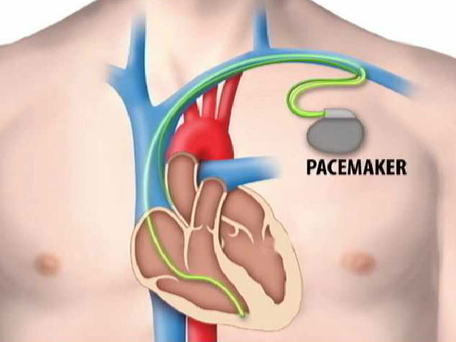 All About Artificial Cardiac Pacemaker