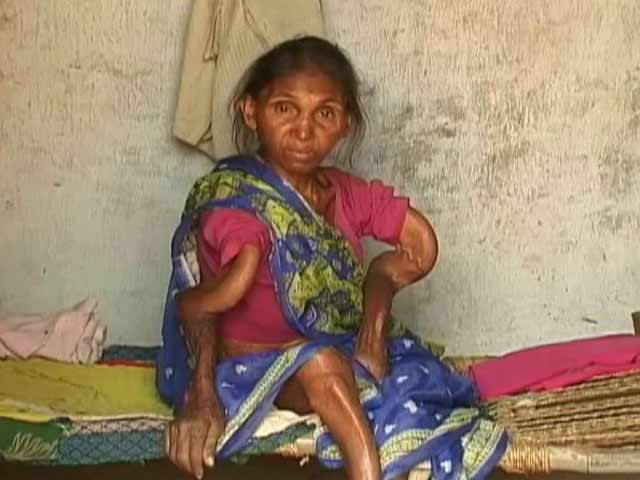 Video : 36 Dead In Jharkhand Village Of Skeletal Fluorosis