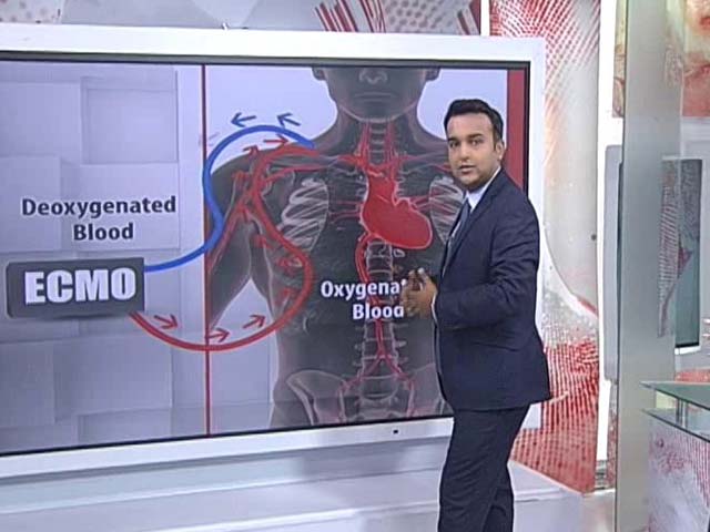 Jayalalithaa on ECMO Support: What Is It, How Does It Work