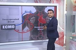 क्या है यह ECMO जिस पर हैं जयललिता क्या है यह ECMO जिस पर हैं जयललिता