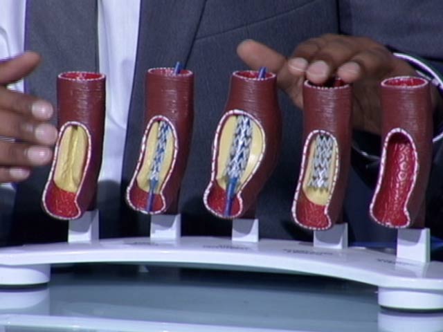 डॉक्टर्स ऑन कॉल : जानिए क्या होता है स्टेंट