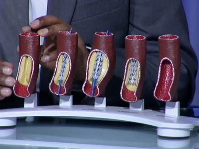 What Is Coronary Stent?