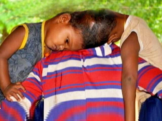 जन्म से सिर से जुड़े ओडिशा के जुड़वां बच्चे ऑपरेशन के लिए एम्स में भर्ती