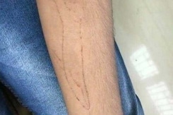 'I Have Come Back': Engineering Student Saved From Blue Whale Suicide Game 'I Have Come Back': Engineering Student Saved From Blue Whale Suicide Game