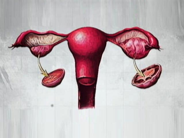 Video : PCOS - A Gynaecological Disorder Every Women Should Know About
